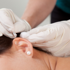 Ear Acupuncture